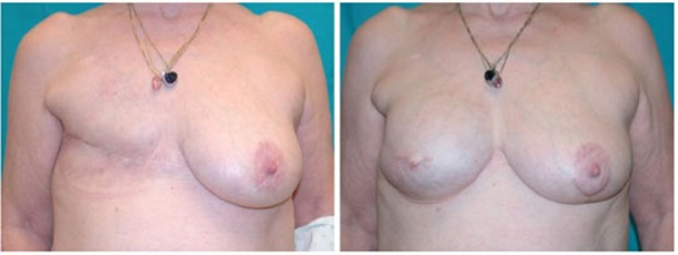 Breast Reconstruction Boston