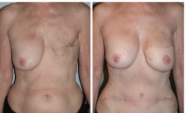 Breast Reconstruction Boston