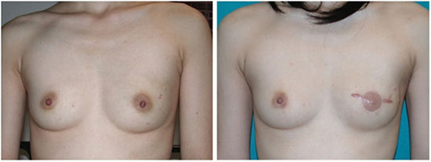 Breast Reconstruction Boston