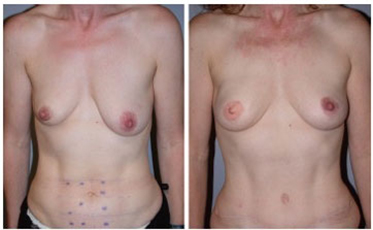 Breast Reconstruction Boston