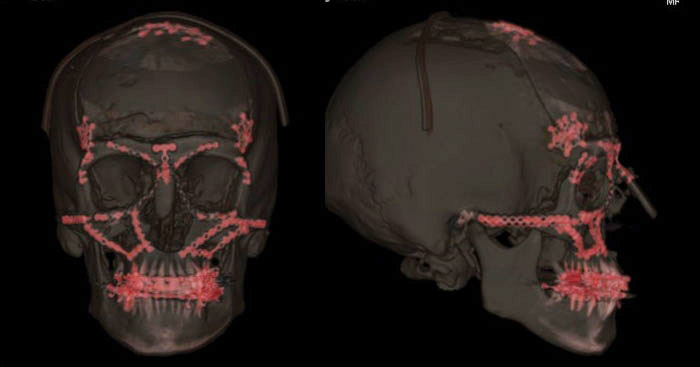 Craniofacial Surgery Boston