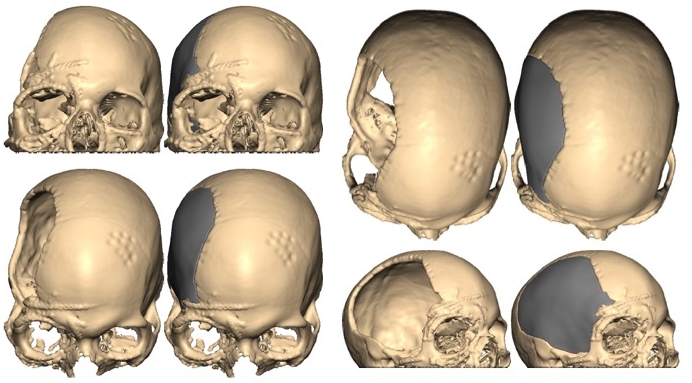 Boston Craniofacial Surgery