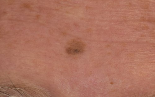 Skin Cancer Treatment Boston
